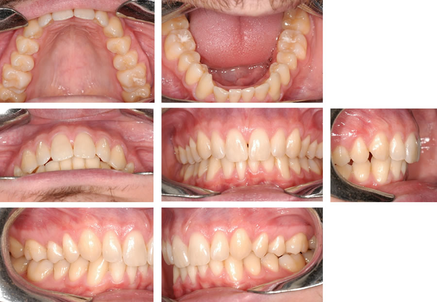 Malposizione Dentaria