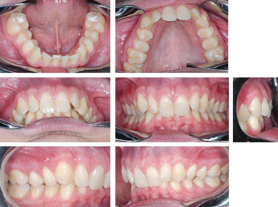 Malposizione Dentaria