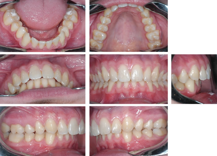 Malposizione Dentaria